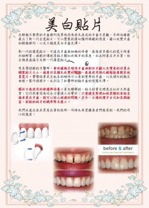 【牙齒美白案例】牙齒美白貼片